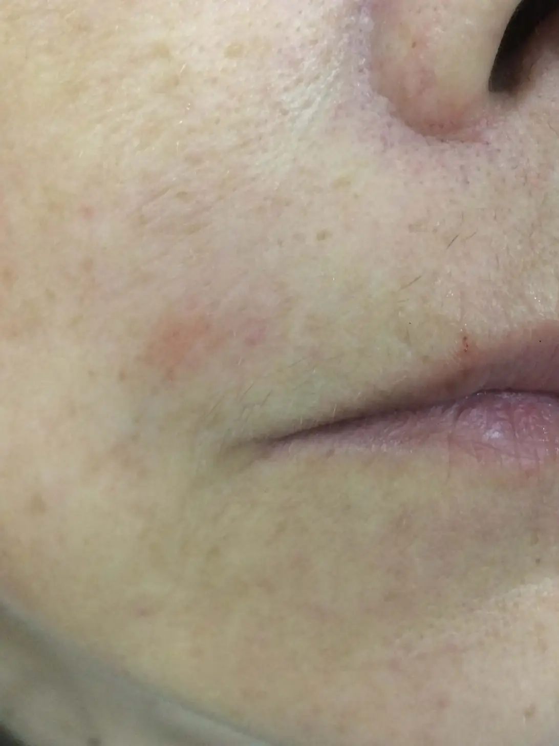 After: Botox